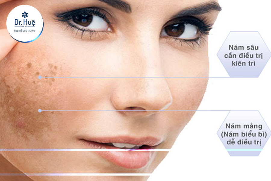 phân biệt nám mảng và nám chân sâu 