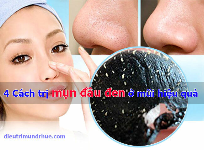 4 Cách trị mụn đầu đen ở mũi hiệu quả