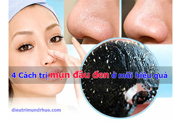4 Cách trị mụn đầu đen ở mũi hiệu quả