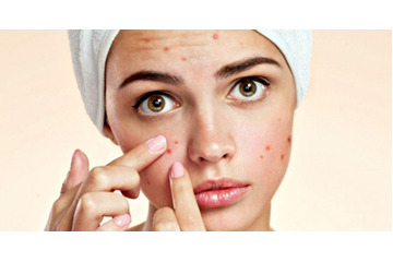 4 Nguyên tắc vàng để điều trị mụn hiệu quả