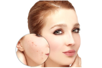 Bạn biết gì về điều trị sẹo rỗ bằng laser?