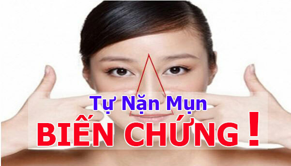 Bạn đã biết đến những biến chứng không thể ngờ từ việc nặn mụn tại nhà chưa?