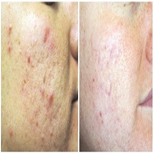 Cảm nhận của bạn Tuyền - 21 tuổi về điều trị mụn Dr. Huệ