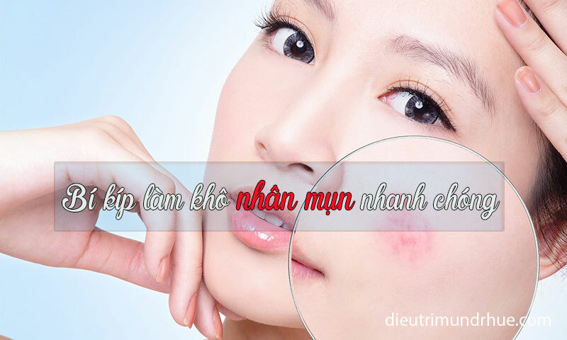 Bí kíp làm khô nhân mụn nhanh chóng