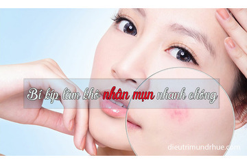 Bí kíp làm khô nhân mụn nhanh chóng