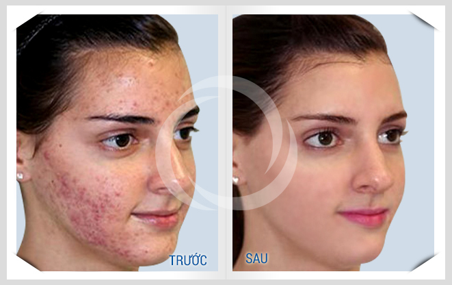 Bí kíp trị mụn bọc vừa nhanh vừa hiệu quả