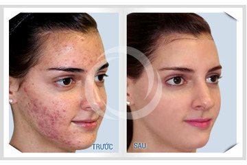 Bí kíp trị mụn bọc vừa nhanh vừa hiệu quả