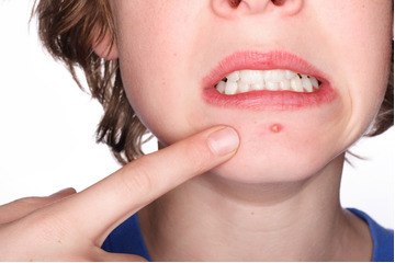 Bí quyết vàng điều trị mụn bọc có mủ