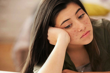 Bị sẹo rỗ lâu năm có chữ khỏi được không?