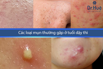 Các Loại Mụn Thường Gặp Ở Tuổi Dậy Thì