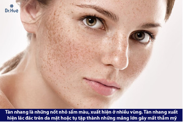 Cách chăm sóc da mặt bị Tàn Nhang hàng ngày