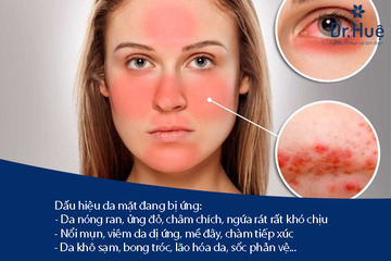 Cách Chăm Sóc Da Mặt Khi Bị Dị Ứng Hiệu Quả Nhất