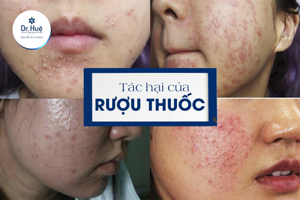 Cách chăm sóc phục hồi da sau khi dùng rượu thuốc