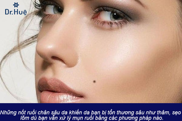 Cách chữa trị sẹo lõm sẹo thâm sau khi tẩy nốt ruồi
