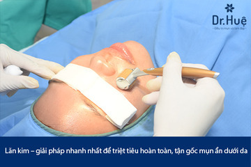 Cách Điều Trị Mụn Ẩn Dưới Da Hiệu Quả Tại Dr. Huệ