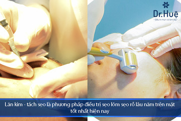 Cách Điều Trị Sẹo Lõm Sẹo Rỗ Lâu Năm Trên Mặt Tốt Nhất Tại Dr. Huệ
