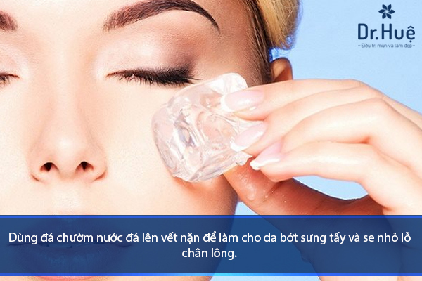 Cách Nặn Mụn Bằng Cây Nặn Mụn An Toàn Không Nhiễm Trùng - Hình 4