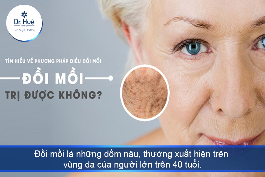 Cách trị tàn nhang và đồi mồi bằng công nghệ cao