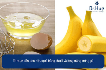 Cách Trị Mụn Bằng Chuối Đơn Giản Dễ Làm Tại Nhà