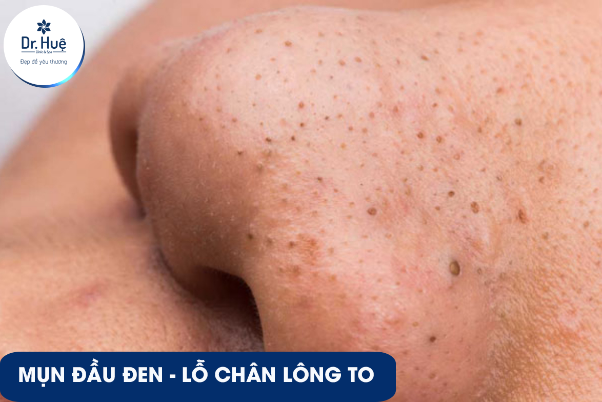 [Top 6] Cách trị mụn đầu đen và lỗ chân lông to hiệu quả