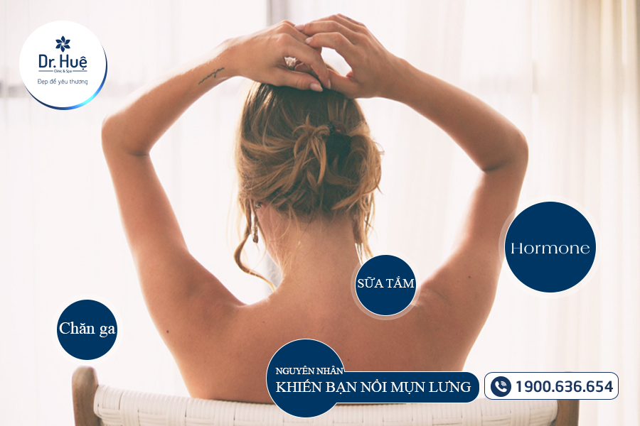 Nguyên nhân bạn nổi mụn lưng 