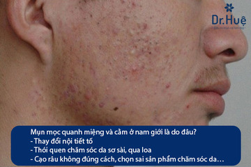 Cách Trị Mụn Mọc Quanh Miệng Và Cằm Ở Nam Giới Chuẩn Y Khoa