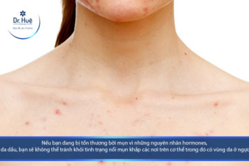 Cách trị mụn ở ngực hiệu quả an toàn