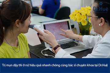 Cách trị mụn ở tuổi dậy thì nữ đơn giản hiệu quả nhất tại Dr. Huệ