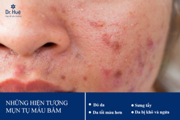 Cách trị mụn thâm tụ máu bầm an toàn theo chuẩn y khoa