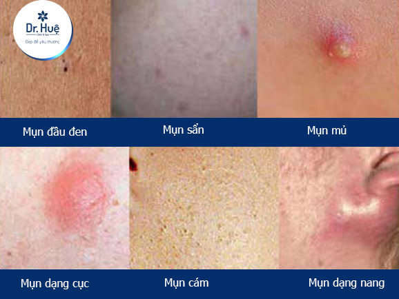 Các loại mụn hình thành nên mụn viêm đỏ 