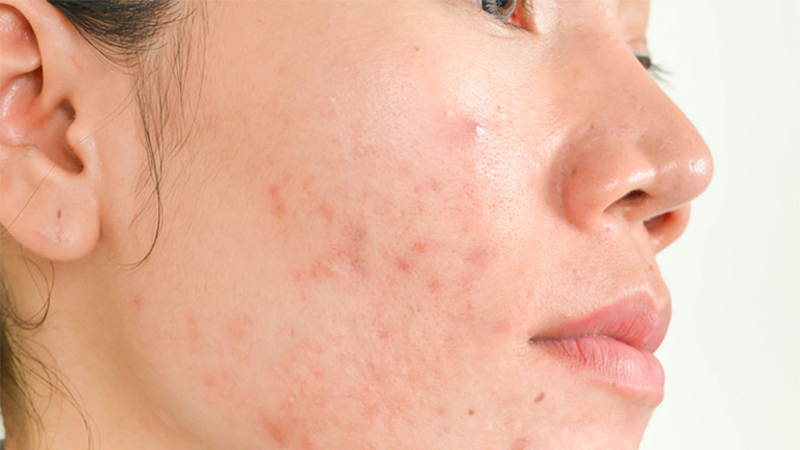 Cách xác định nguyên nhân gây mụn