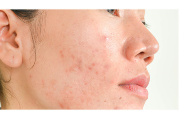 Cách xác định nguyên nhân gây mụn