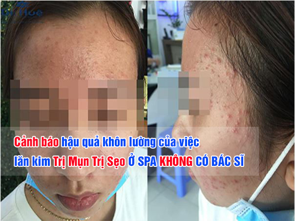 Cảnh báo hậu quả khôn lường của việc Nano Basic Trị Mụn Trị Sẹo Ở SPA KHÔNG CÓ BÁC SĨ