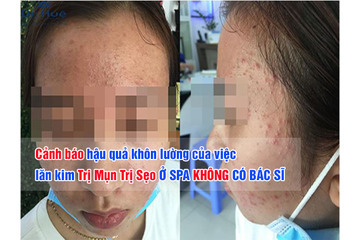 Cảnh báo hậu quả khôn lường của việc Nano Basic Trị Mụn Trị Sẹo Ở SPA KHÔNG CÓ BÁC SĨ