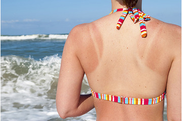 Cấp cứu da cháy nắng ngay lập tức