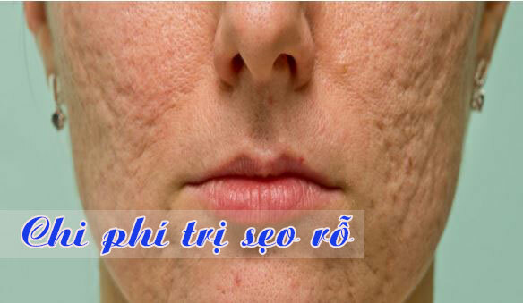 Chi phí cho một lần Nano Basic trị sẹo rỗ tại địa chỉ uy tín