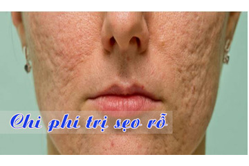 Chi phí cho một lần Nano Basic trị sẹo rỗ tại địa chỉ uy tín