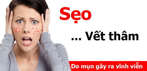 Điều trị mụn tận gốc tại đâu tốt nhất? - Điều trị mụn Dr Huệ - Hình 1