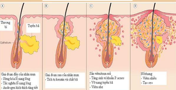 Điều trị mụn tận gốc tại đâu tốt nhất? - Điều trị mụn Dr Huệ - Hình 3