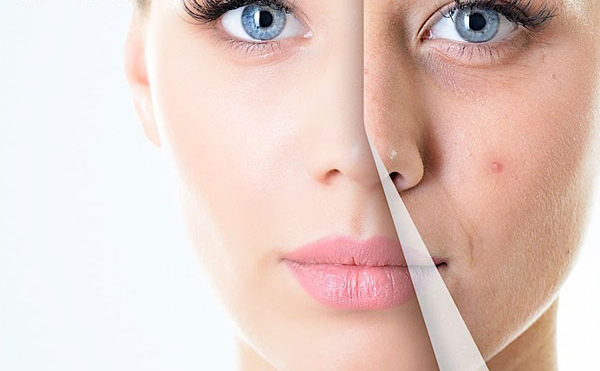 Có thể điều trị mụn vĩnh viễn không?