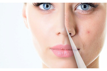 Có thể điều trị mụn vĩnh viễn không?