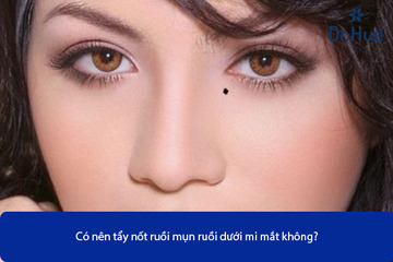 Có Nên Tẩy Nốt Ruồi Mụn Ruồi Dưới Mi Mắt Không