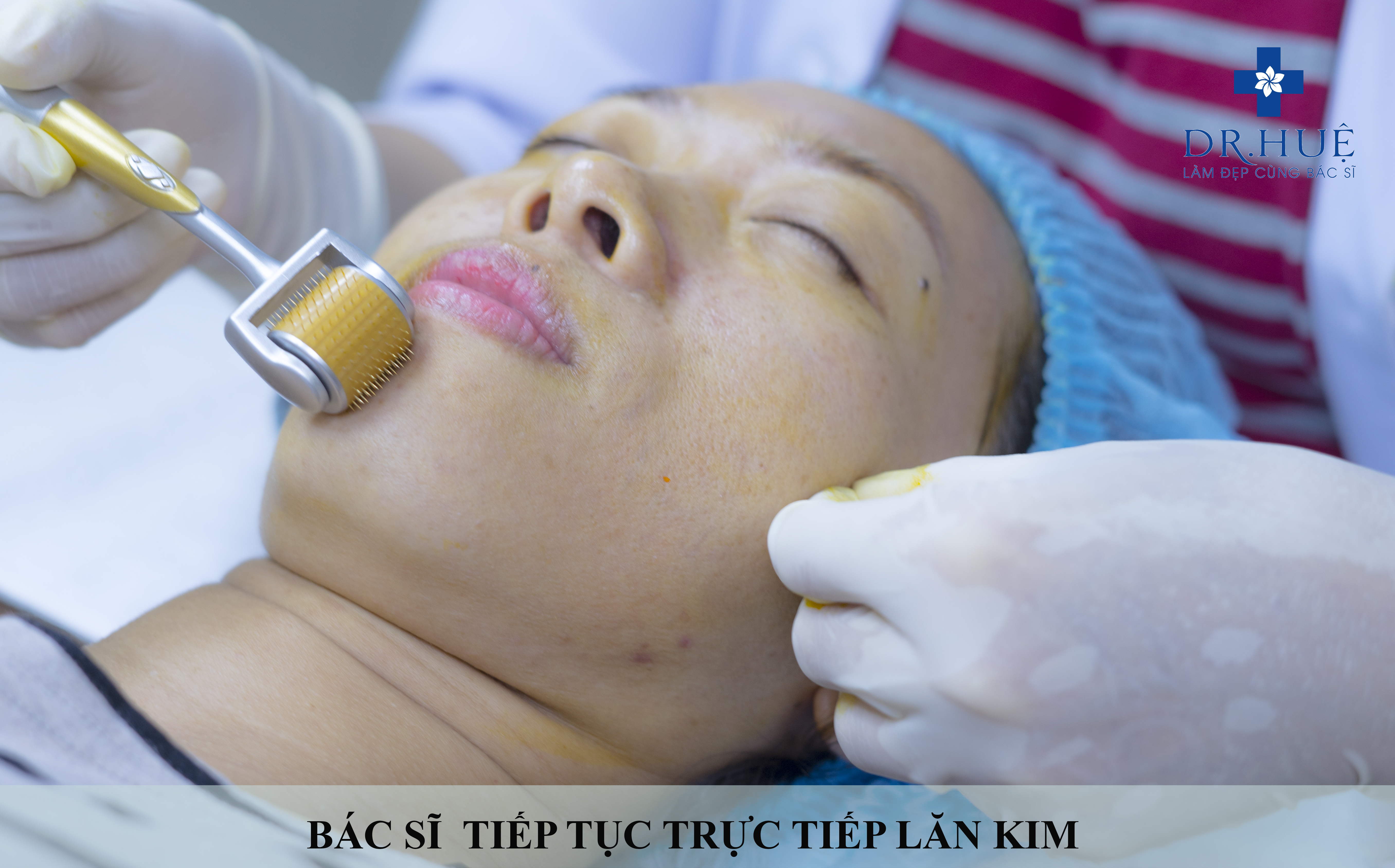 Có nhất thiết phải dùng phương pháp lăn kim để trị sẹo rỗ không?