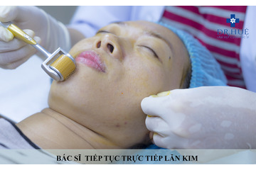 Có nhất thiết phải dùng phương pháp lăn kim để trị sẹo rỗ không?