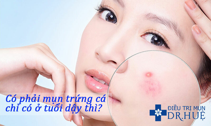 Có phải mụn trứng cá chỉ có ở tuổi dậy thì?