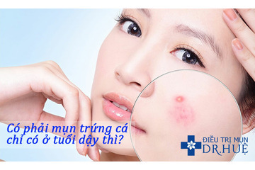 Có phải mụn trứng cá chỉ có ở tuổi dậy thì?