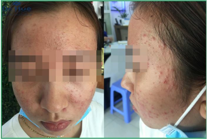Da bị kích ứng, nhiễm corticoid do Nano Basic sai cách và sử dụng mỹ phẩm không rõ nguồn gốc