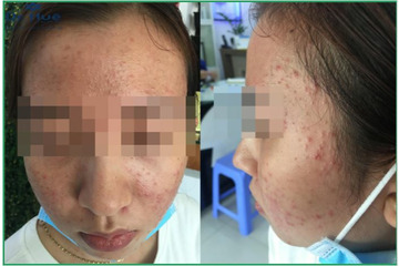 Da bị kích ứng, nhiễm corticoid do Nano Basic sai cách và sử dụng mỹ phẩm không rõ nguồn gốc