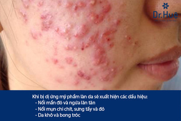 Da Mặt Dị Ứng Mỹ Phẩm Có Tự Hết Không Hay Bao Lâu Thì Khỏi