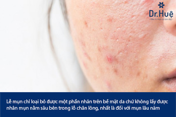 Đi Lễ Mụn Có Tốt Không Có Hiệu Quả Không